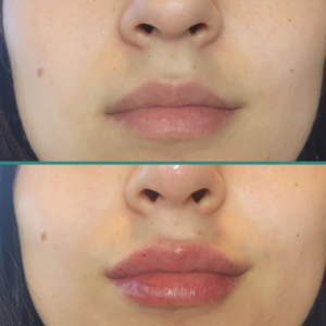 Before After 1