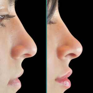 Before After 2