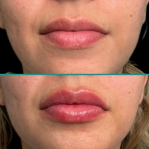 Before After 8