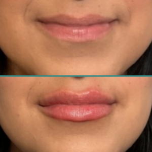 Before After 9